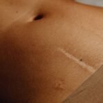 Cintas abdominais pós cesárea