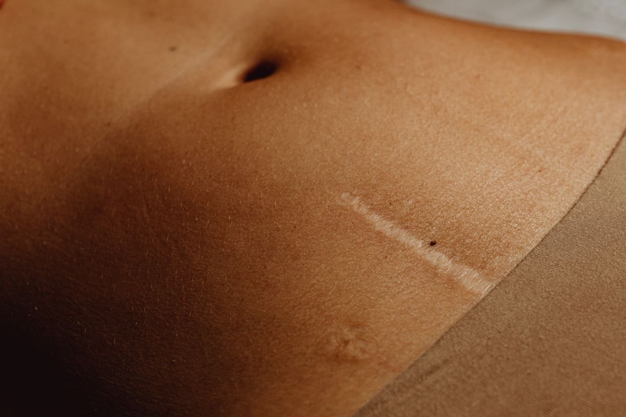 Cintas abdominais pós cesárea: 9 indicações e cuidados!